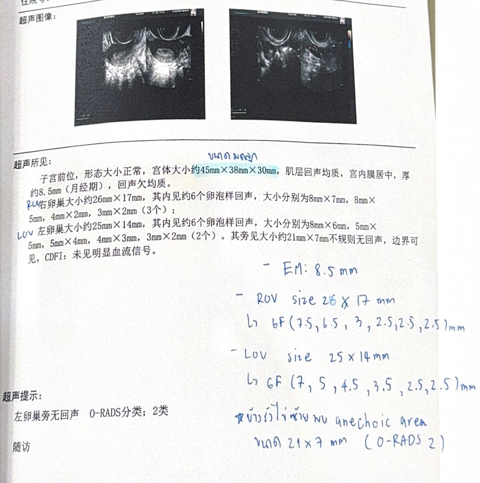 33 岁卵泡发育不同步:温和刺激二次促排,3 颗卵全部成囊,PGT-A 后移植成功