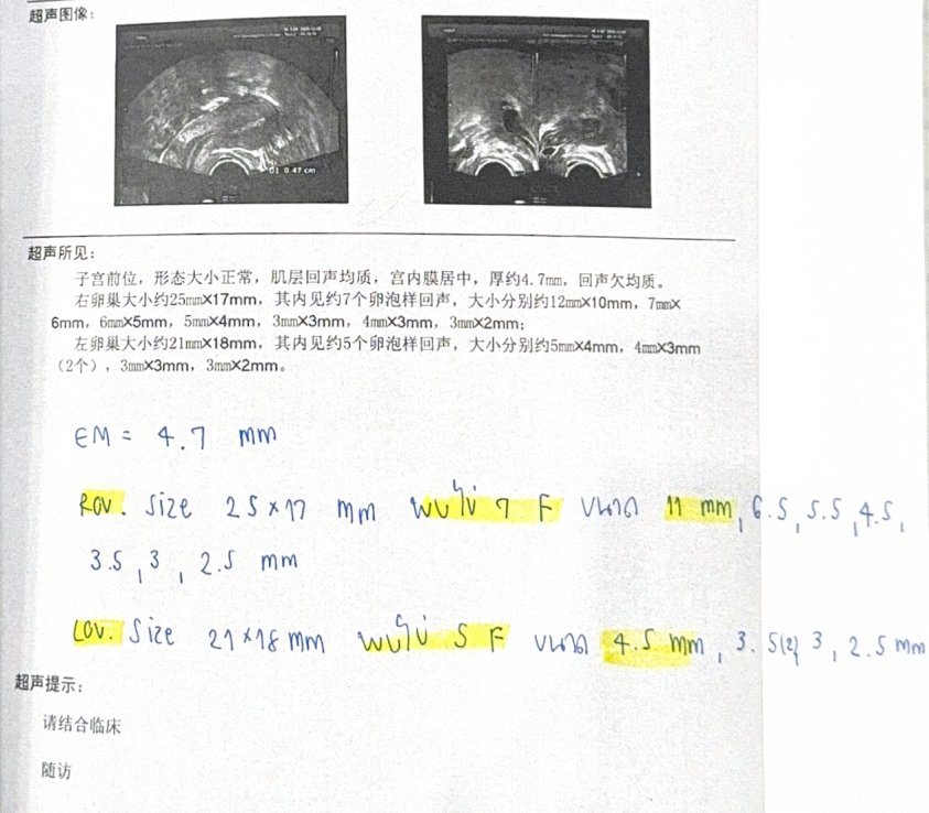 33 岁卵泡发育不同步:温和刺激二次促排,3 颗卵全部成囊,PGT-A 后移植成功