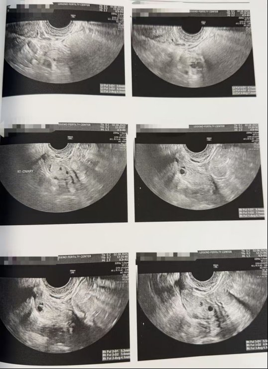 40 岁高龄冻卵,一年后解冻受精:10 颗卵养成 5 枚囊胚,获 2 枚健康胚胎