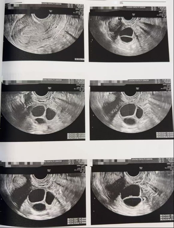 40 岁高龄冻卵,一年后解冻受精:10 颗卵养成 5 枚囊胚,获 2 枚健康胚胎
