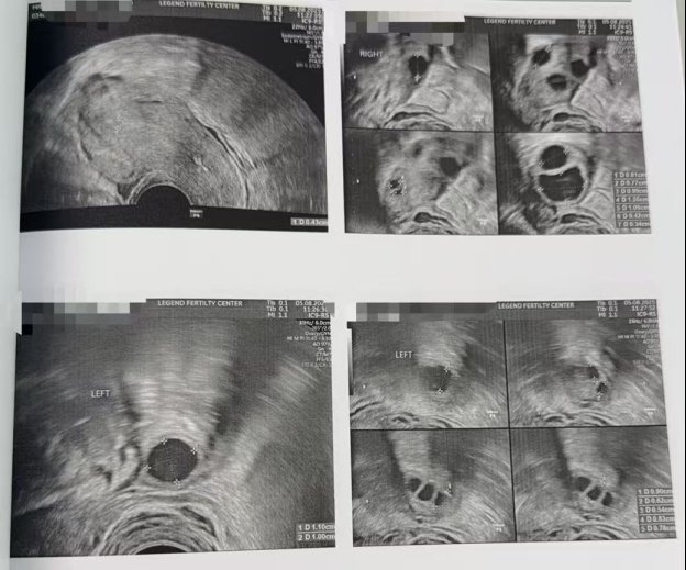 40 岁高龄冻卵,一年后解冻受精:10 颗卵养成 5 枚囊胚,获 2 枚健康胚胎