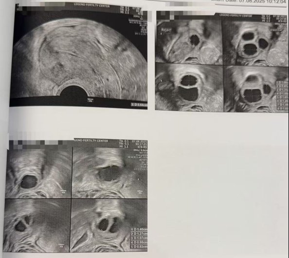 40 岁高龄冻卵,一年后解冻受精:10 颗卵养成 5 枚囊胚,获 2 枚健康胚胎