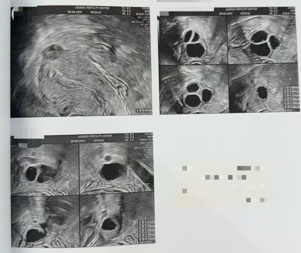 40 岁高龄冻卵,一年后解冻受精:10 颗卵养成 5 枚囊胚,获 2 枚健康胚胎