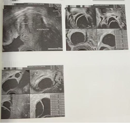 28 岁卵巢早衰、卵泡大小不一:5 颗受精卵全部成囊,3 枚过筛可移植
