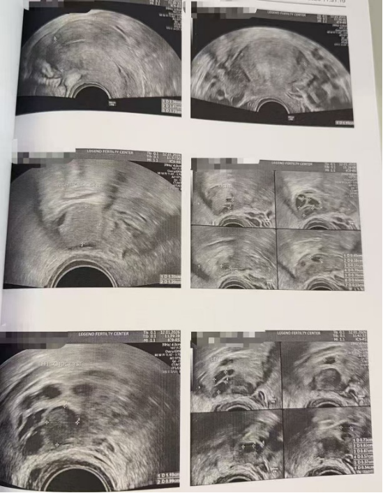 28 岁双侧巧克力囊肿 + 男方精子差:取卵 20 颗、养囊成功 11 颗