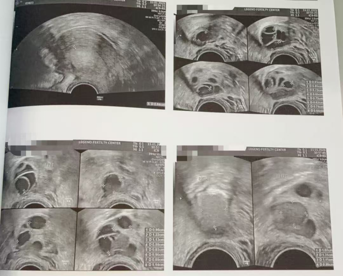 28 岁双侧巧克力囊肿 + 男方精子差:取卵 20 颗、养囊成功 11 颗