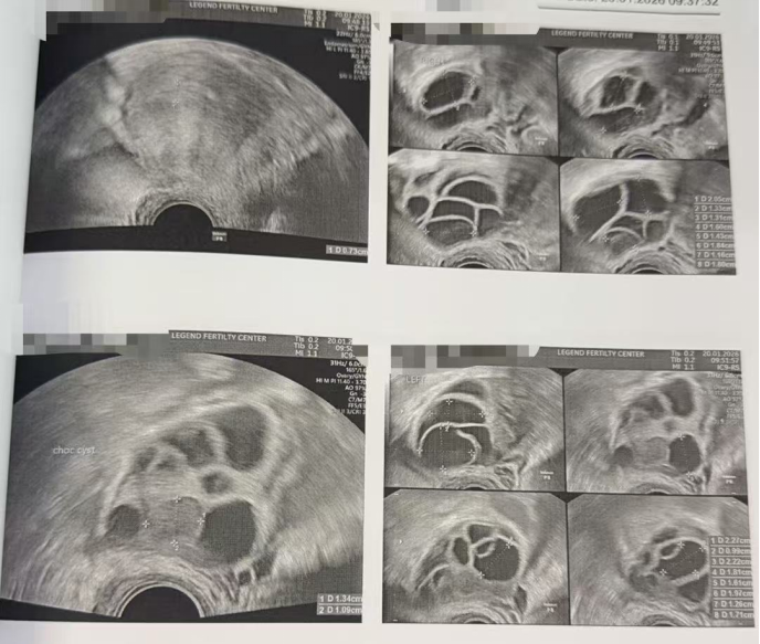 28 岁双侧巧克力囊肿 + 男方精子差:取卵 20 颗、养囊成功 11 颗