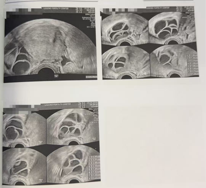 28 岁双侧巧克力囊肿 + 男方精子差:取卵 20 颗、养囊成功 11 颗