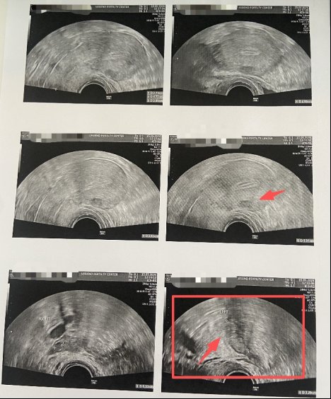 33 岁卵巢早衰,AMH 仅 0.2,伴盆腔粘连:温和刺激 5 颗卵养成 4 颗囊胚