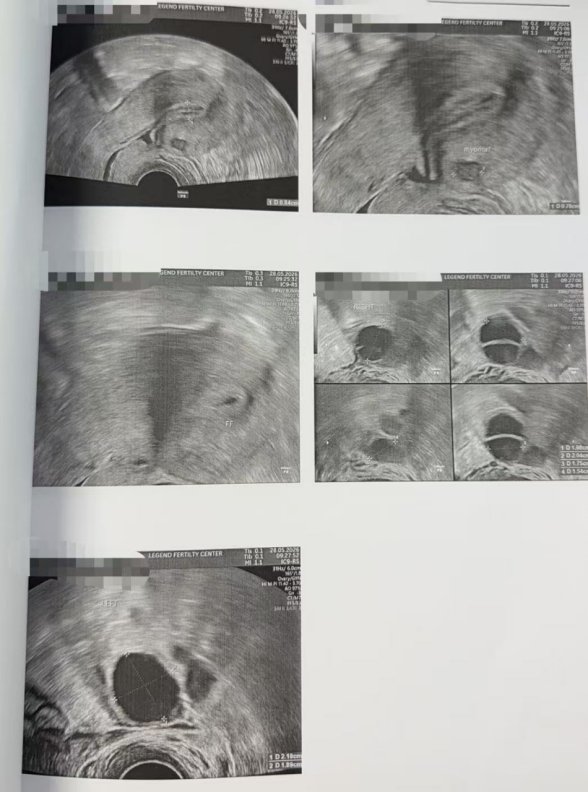 33 岁卵巢早衰,AMH 仅 0.2,伴盆腔粘连:温和刺激 5 颗卵养成 4 颗囊胚