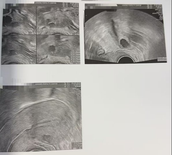 33 岁卵巢早衰,AMH 仅 0.2,伴盆腔粘连:温和刺激 5 颗卵养成 4 颗囊胚