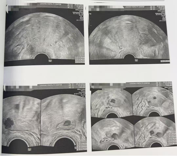 33 岁卵巢早衰 + 男方精子活力仅 1%:PICSI 选精,4 颗受精卵全部成囊