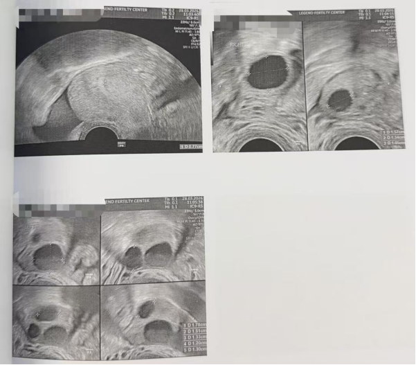 33 岁卵巢早衰 + 男方精子活力仅 1%:PICSI 选精,4 颗受精卵全部成囊