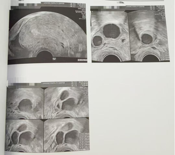 33 岁卵巢早衰 + 男方精子活力仅 1%:PICSI 选精,4 颗受精卵全部成囊