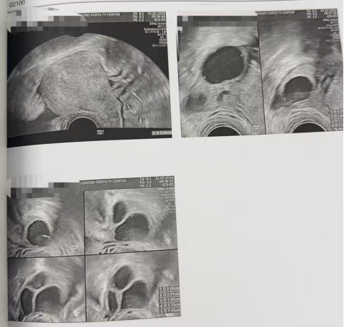 33 岁卵巢早衰 + 男方精子活力仅 1%:PICSI 选精,4 颗受精卵全部成囊