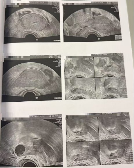35 岁错过月经期还能促排吗?LRC 黄体期促排:12 颗成熟卵养囊 10 枚