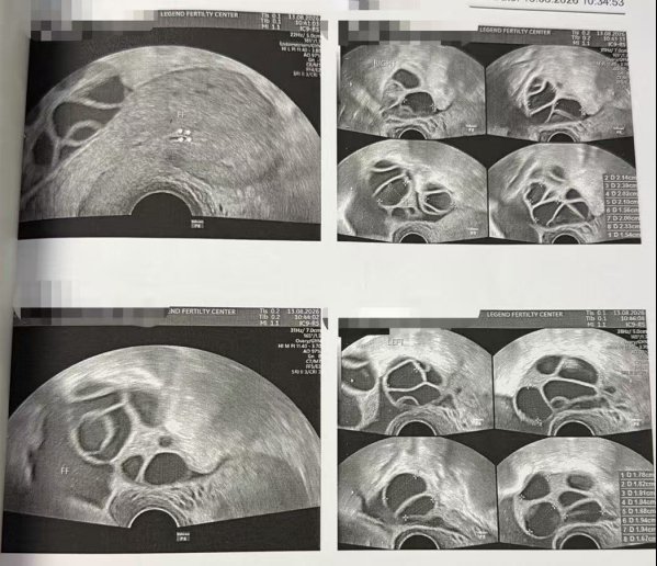 35 岁错过月经期还能促排吗?LRC 黄体期促排:12 颗成熟卵养囊 10 枚