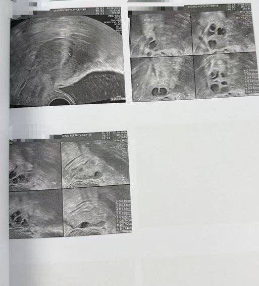 35 岁错过月经期还能促排吗?LRC 黄体期促排:12 颗成熟卵养囊 10 枚