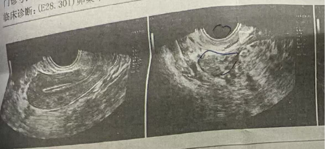 37 岁卵巢衰退 + 男方精子差:温和刺激仅取卵 3 颗养成 2 枚囊胚