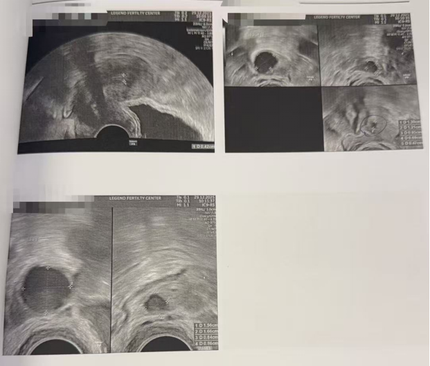 37 岁卵巢衰退 + 男方精子差:温和刺激仅取卵 3 颗养成 2 枚囊胚