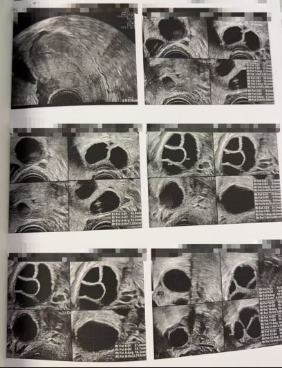 39 岁 FSH 从 13 降到 9:LRC 个性化调理 + 促排,8 卵全熟养出 5 枚囊胚