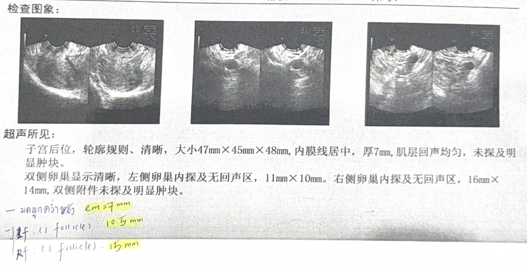 40 岁高龄试管实录:基础卵泡仅 2 颗,温和刺激促排,取卵 4 颗、成囊 1 颗