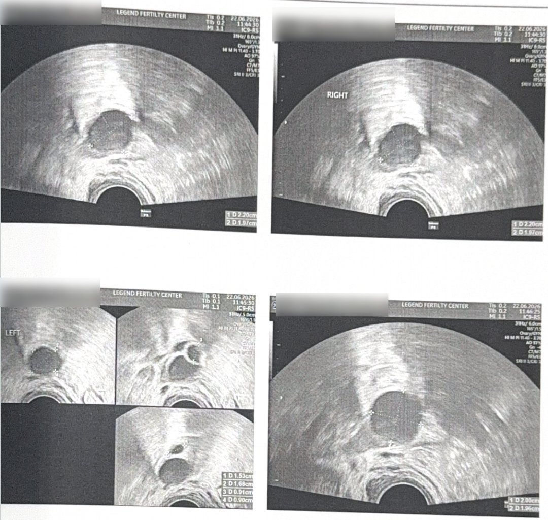 40 岁高龄试管实录:基础卵泡仅 2 颗,温和刺激促排,取卵 4 颗、成囊 1 颗
