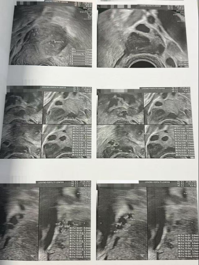 40 岁高龄,10 颗成熟卵全部成囊:这次促排,LRC 更关注「有效转化」