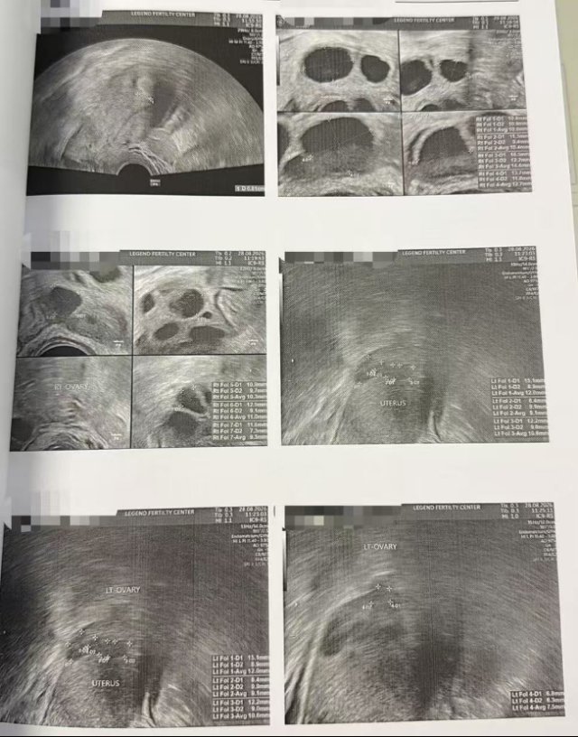 40 岁高龄,10 颗成熟卵全部成囊:这次促排,LRC 更关注「有效转化」