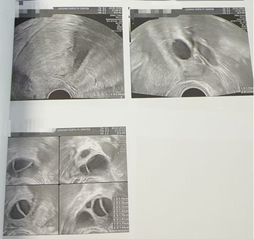40 岁卵泡不均 + 47 岁精子双低:4 颗受精胚胎全部成囊,过筛 2 枚