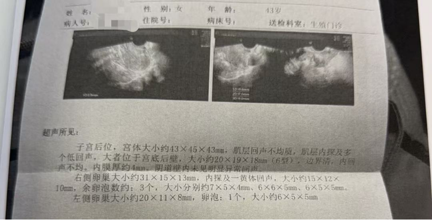 43 岁 AMH 仅 0.11 + 男方精子差:温和刺激实现“2 卵 1 囊”翻盘