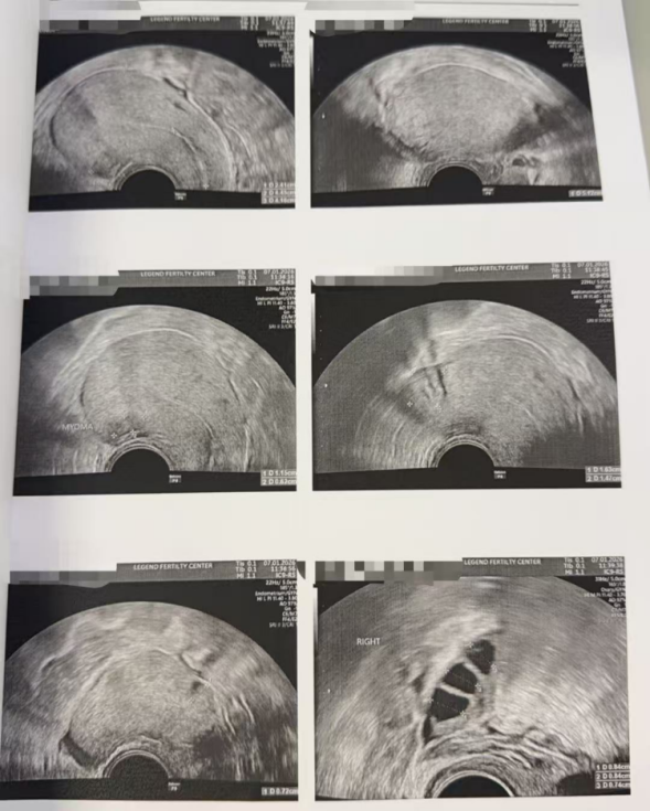 43 岁 AMH 仅 0.11 + 男方精子差:温和刺激实现“2 卵 1 囊”翻盘