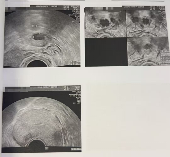 43 岁 AMH 仅 0.11 + 男方精子差:温和刺激实现“2 卵 1 囊”翻盘