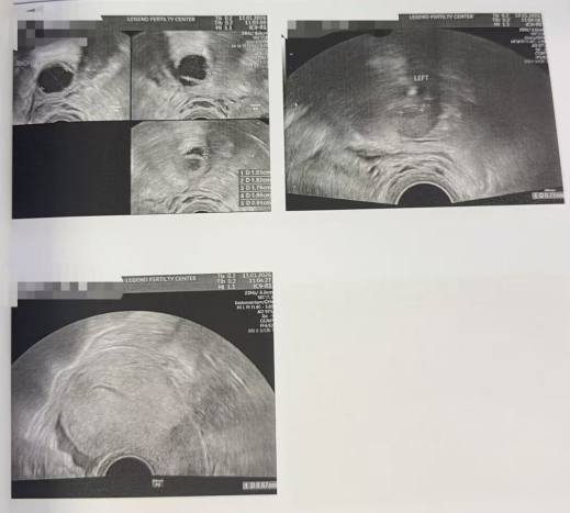 43 岁 AMH 仅 0.11 + 男方精子差:温和刺激实现“2 卵 1 囊”翻盘
