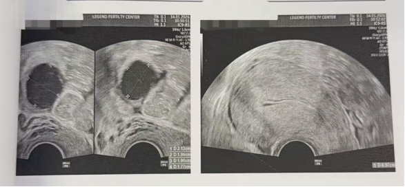 43 岁 AMH 仅 0.11 + 男方精子差:温和刺激实现“2 卵 1 囊”翻盘