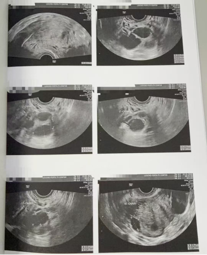 43+47 双高龄:精细化调理 + 个性化促排,取卵 10 颗全成熟、成囊 6 颗