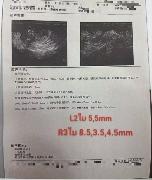 44 岁 AMH 仅 0.8:温和刺激获卵 2 颗,唯一成熟卵养成囊胚并通过 PGT-A