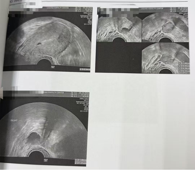 44 岁 AMH 仅 0.8:温和刺激获卵 2 颗,唯一成熟卵养成囊胚并通过 PGT-A