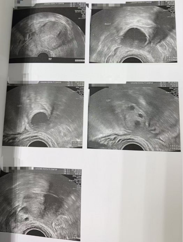 44 岁 AMH 仅 0.8:温和刺激获卵 2 颗,唯一成熟卵养成囊胚并通过 PGT-A
