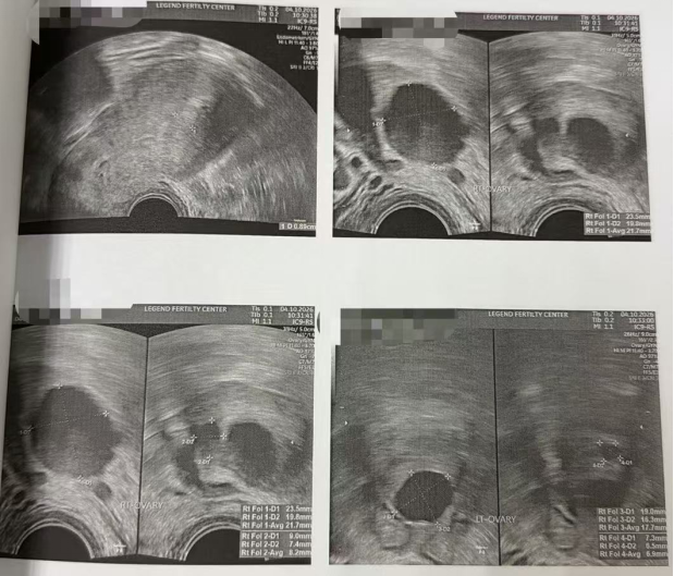 44 岁 AMH 仅 0.8:温和刺激获卵 2 颗,唯一成熟卵养成囊胚并通过 PGT-A