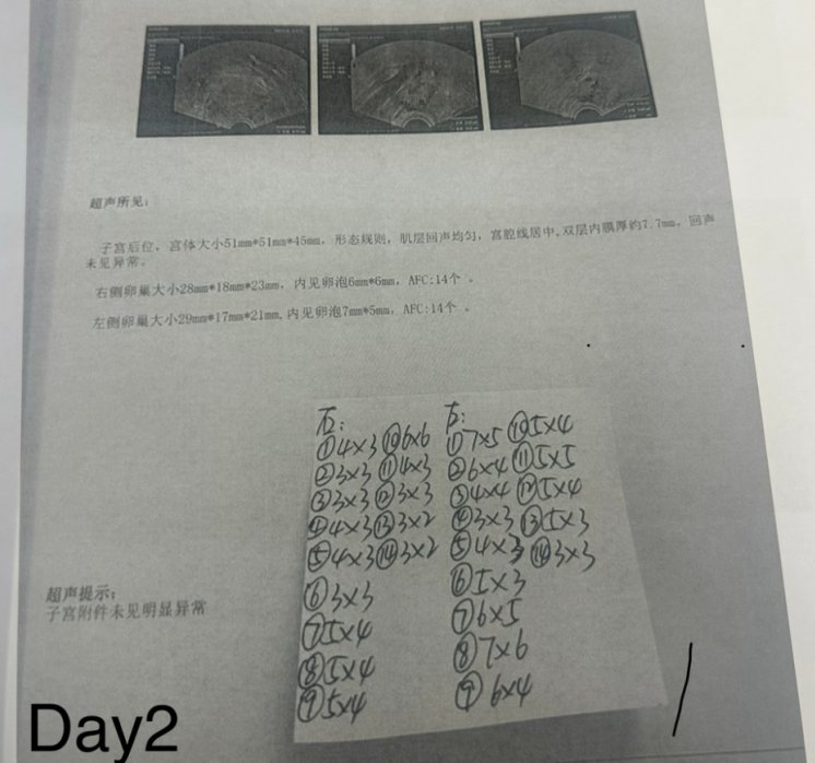 28 岁染色体平衡易位赴泰试管:PGT-SR + MaReCs 一次促排获 2 枚健康胚胎,移植成功好孕