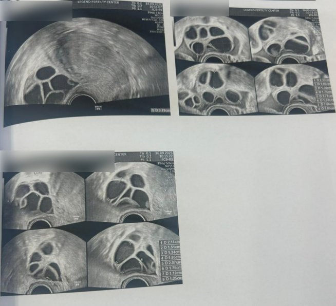 28 岁染色体平衡易位赴泰试管:PGT-SR + MaReCs 一次促排获 2 枚健康胚胎,移植成功好孕