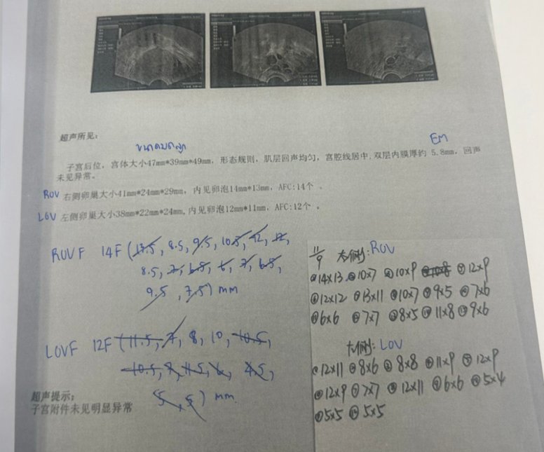28 岁染色体平衡易位赴泰试管:PGT-SR + MaReCs 一次促排获 2 枚健康胚胎,移植成功好孕