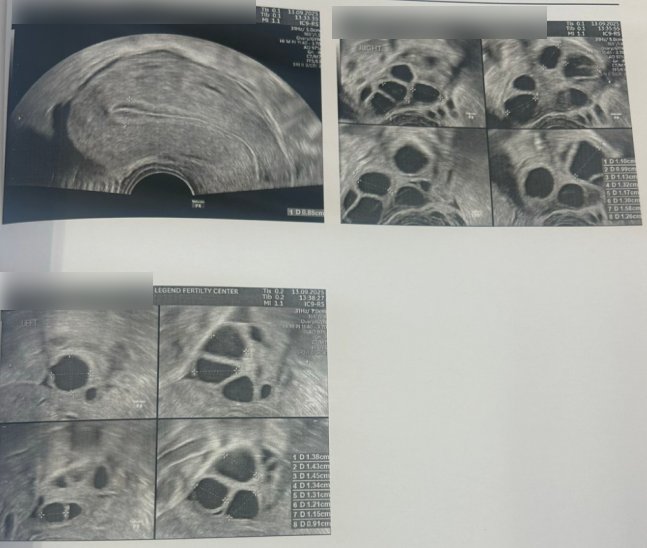 28 岁染色体平衡易位赴泰试管:PGT-SR + MaReCs 一次促排获 2 枚健康胚胎,移植成功好孕