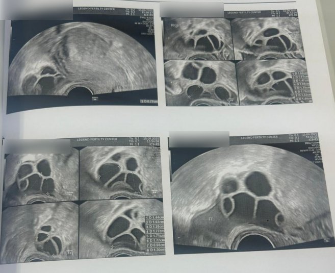 28 岁染色体平衡易位赴泰试管:PGT-SR + MaReCs 一次促排获 2 枚健康胚胎,移植成功好孕