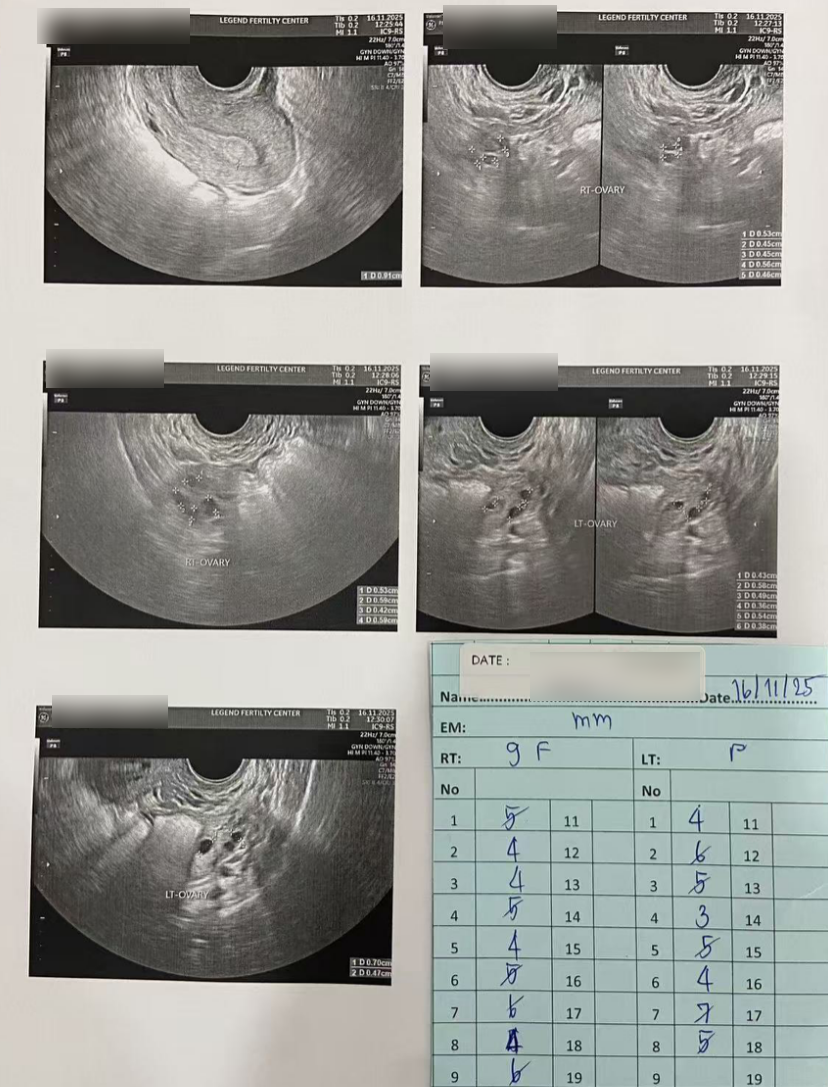 男方 69 岁重度弱精(活力仅 1%):DGC 精子优化 + ICSI,6 周见胎心