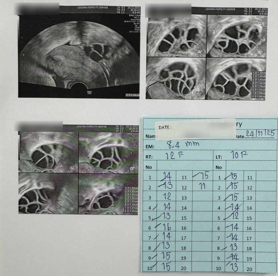男方 69 岁重度弱精(活力仅 1%):DGC 精子优化 + ICSI,6 周见胎心