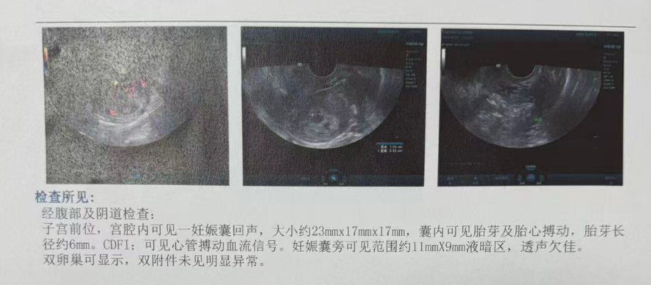 男方 69 岁重度弱精(活力仅 1%):DGC 精子优化 + ICSI,6 周见胎心